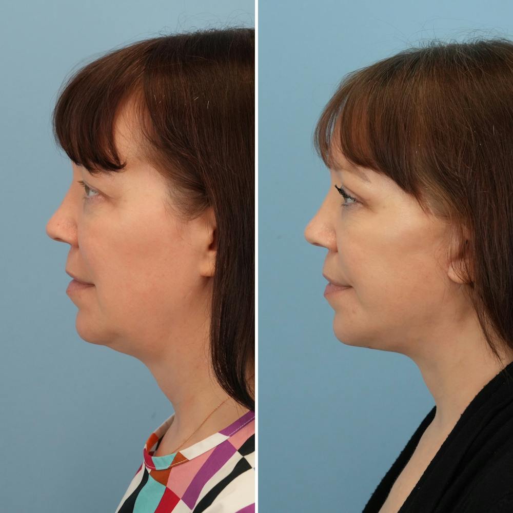 Facelift Before & After Gallery - Patient 176884076 - Image 3