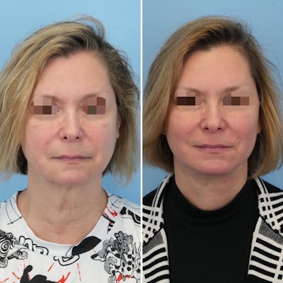 Facelift Before & After Gallery - Patient 176884078 - Image 1