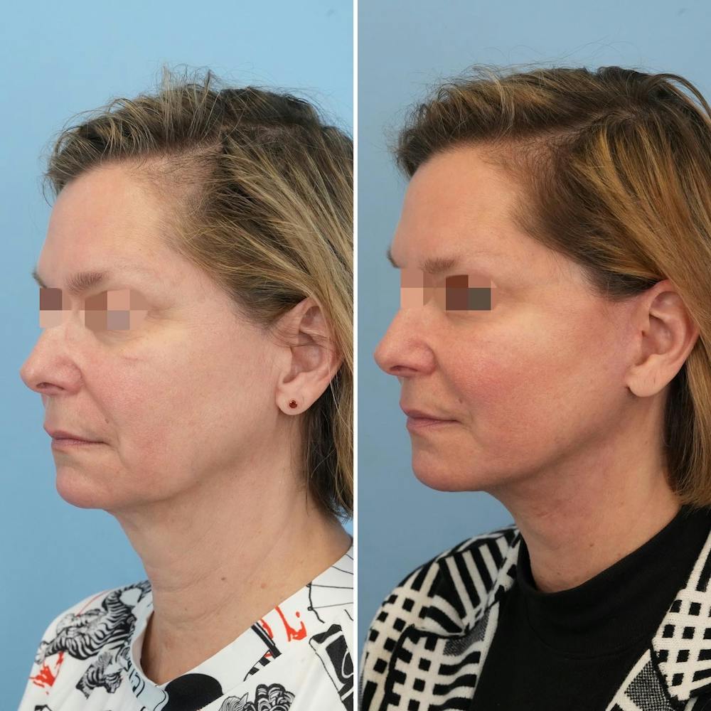 Facelift Before & After Gallery - Patient 176884078 - Image 4
