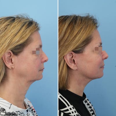 Facelift Before & After Gallery - Patient 176884078 - Image 1