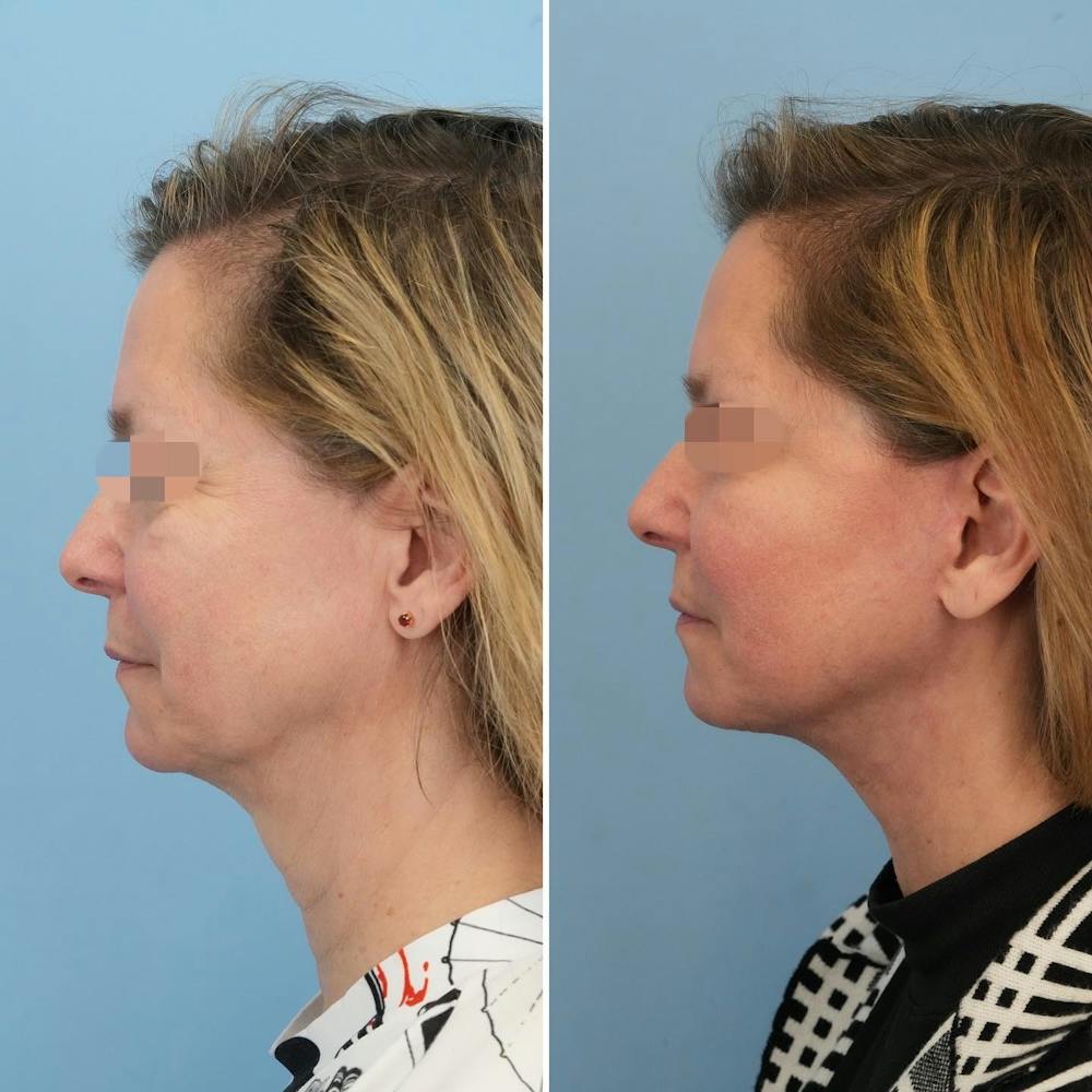Facelift Before & After Gallery - Patient 176884078 - Image 5