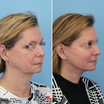 Facelift Before & After Gallery - Patient 176884078 - Image 2