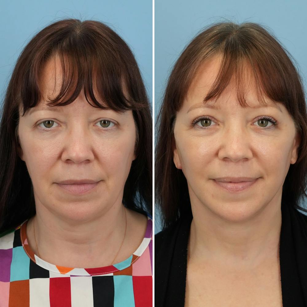 Facelift Before & After Gallery - Patient 176884076 - Image 2