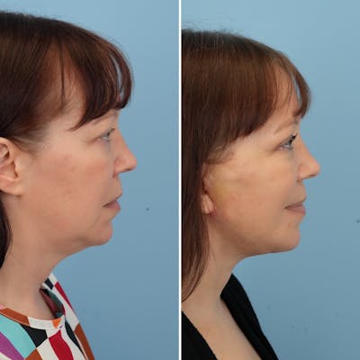 Facelift Before & After Gallery - Patient 176884076 - Image 1
