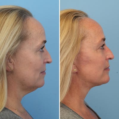 Facelift Before & After Gallery - Patient 176884077 - Image 1