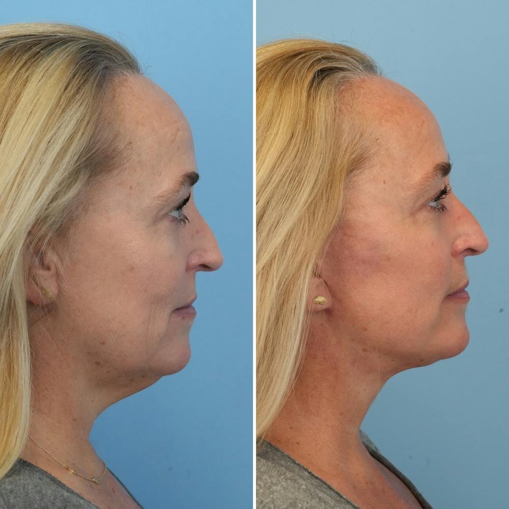 Facelift Before & After Gallery - Patient 176884077 - Image 1