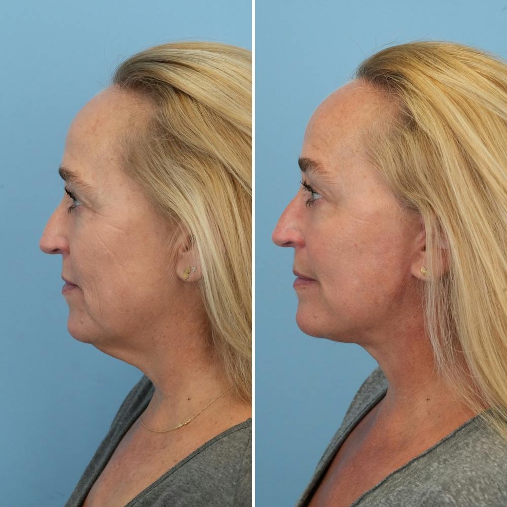 Facelift Before & After Gallery - Patient 176884077 - Image 5