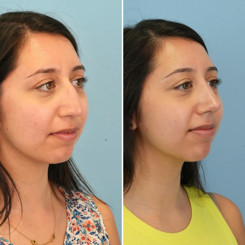 Rhinoplasty Before & After Gallery - Patient 176984817 - Image 3