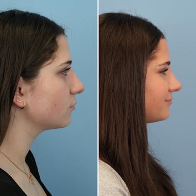 Rhinoplasty Before & After Gallery - Patient 176984807 - Image 2