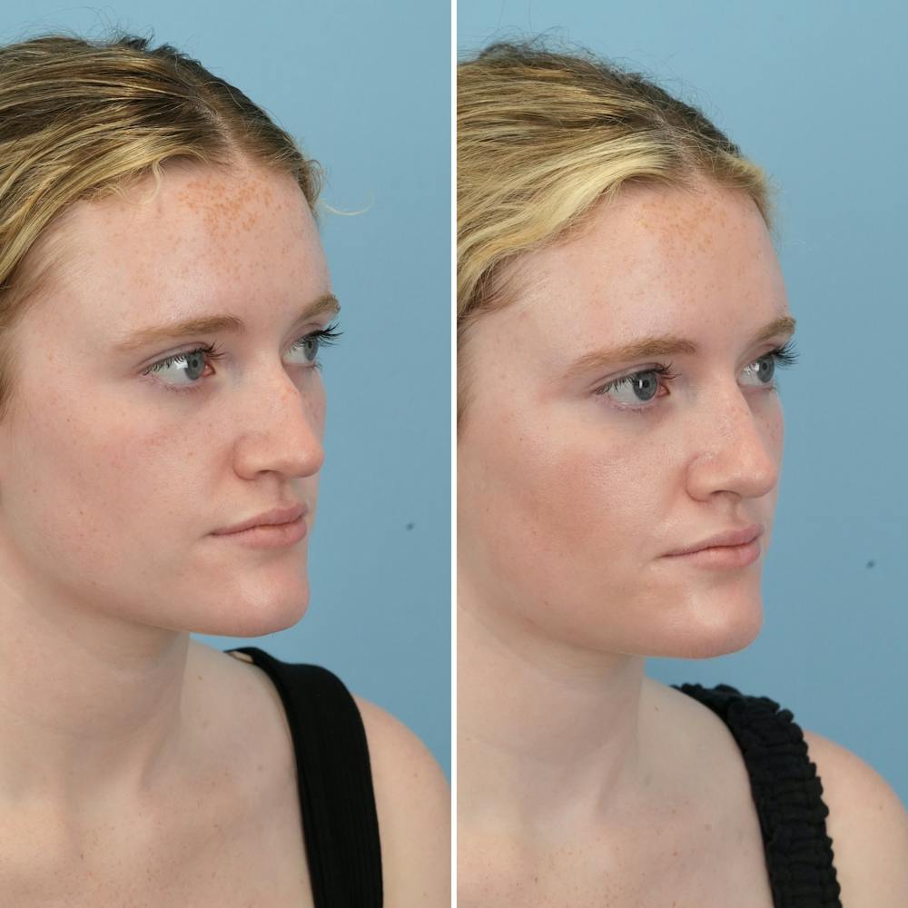 Rhinoplasty Before & After Gallery - Patient 176984344 - Image 3