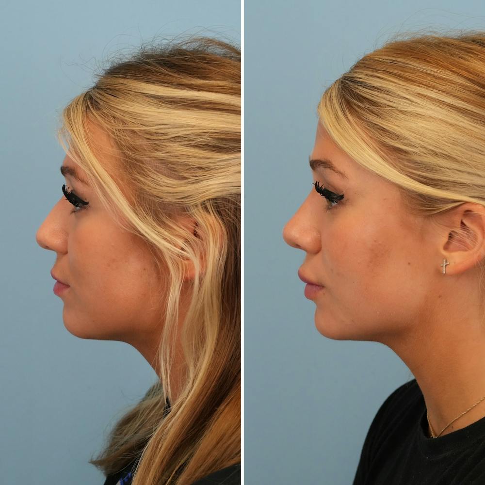 Rhinoplasty Before & After Gallery - Patient 176984798 - Image 1