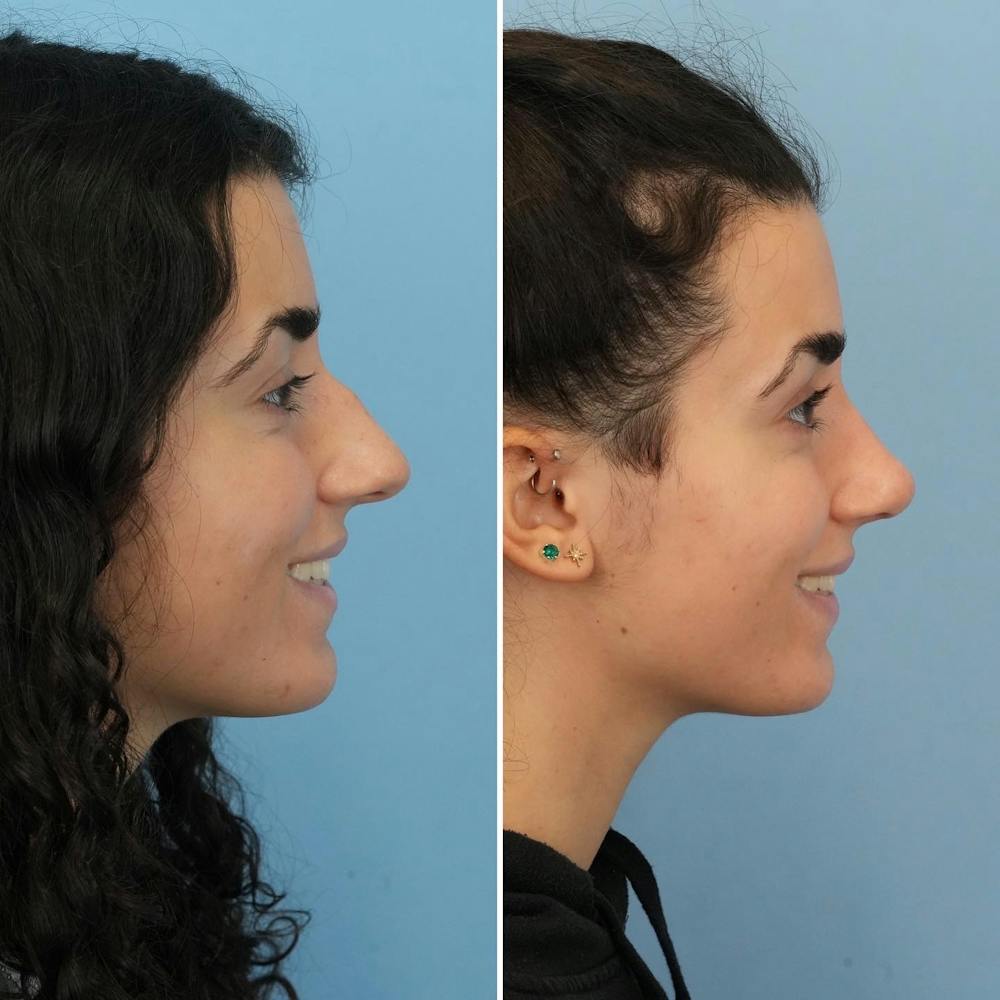 Rhinoplasty Before & After Gallery - Patient 176984797 - Image 2