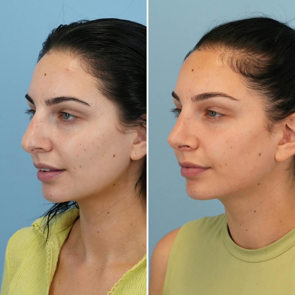Rhinoplasty Before & After Gallery - Patient 176984803 - Image 3