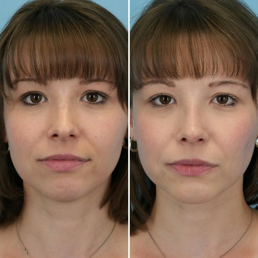 Rhinoplasty Before & After Gallery - Patient 176984799 - Image 5