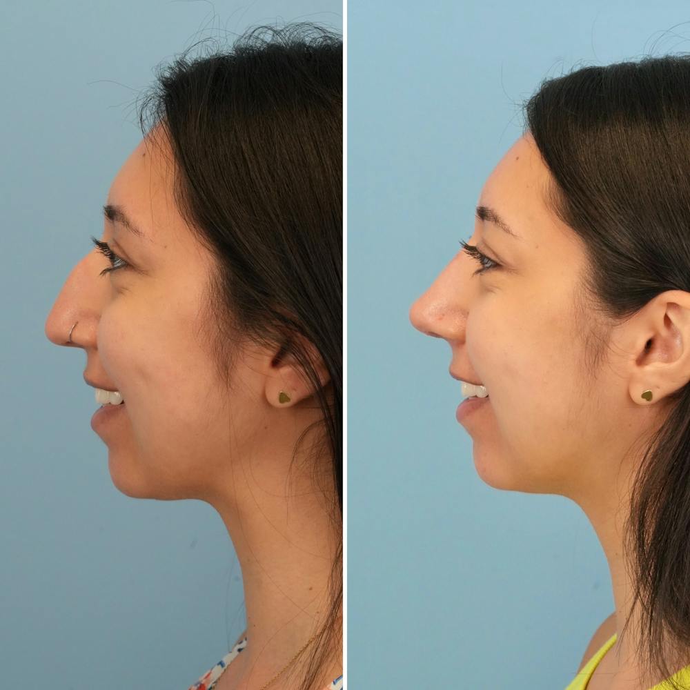 Rhinoplasty Before & After Gallery - Patient 176984817 - Image 1