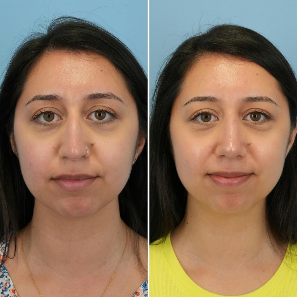 Rhinoplasty Before & After Gallery - Patient 176984817 - Image 4