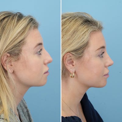 Rhinoplasty Before & After Gallery - Patient 176984805 - Image 1