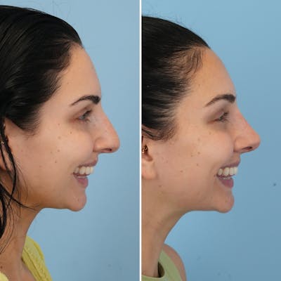 Rhinoplasty Before & After Gallery - Patient 176984803 - Image 4