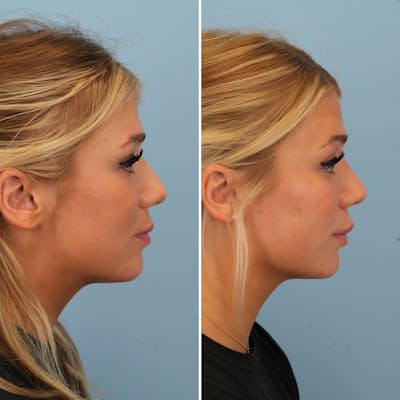 Rhinoplasty Before & After Gallery - Patient 176984798 - Image 2