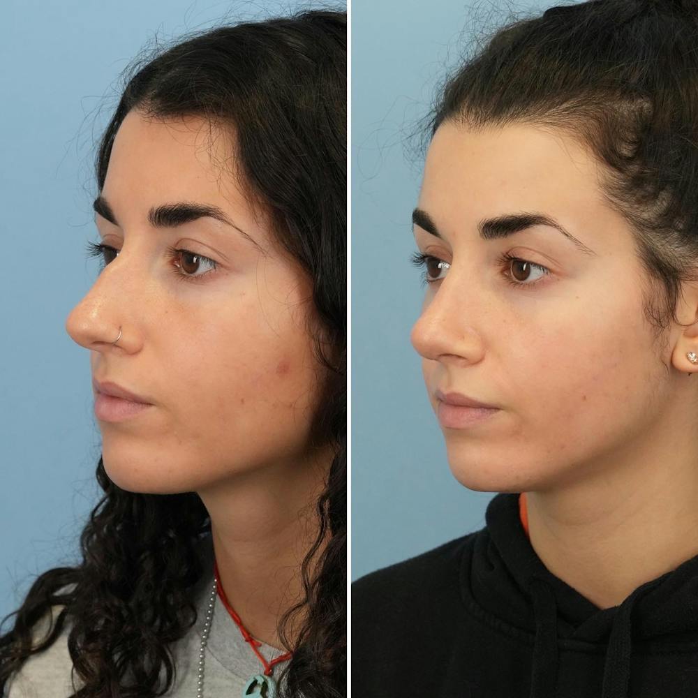 Rhinoplasty Before & After Gallery - Patient 176984797 - Image 3