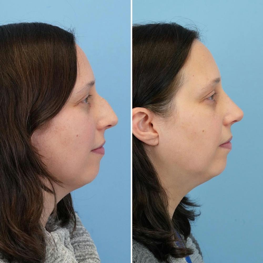 Rhinoplasty Before & After Gallery - Patient 176984804 - Image 2