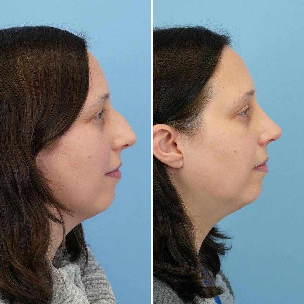 Rhinoplasty Before & After Gallery - Patient 176984804 - Image 2