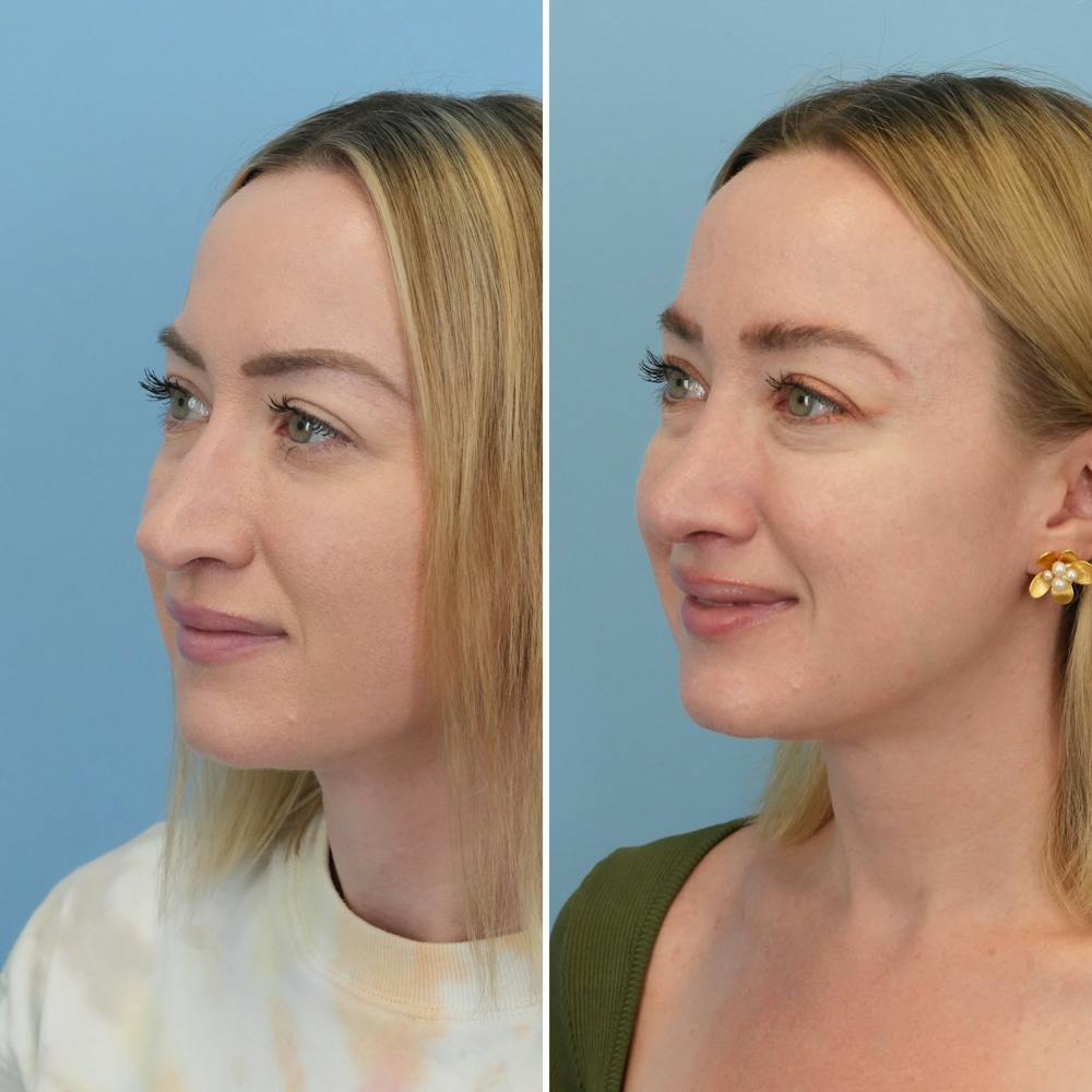 Rhinoplasty Before & After Gallery - Patient 176984818 - Image 1