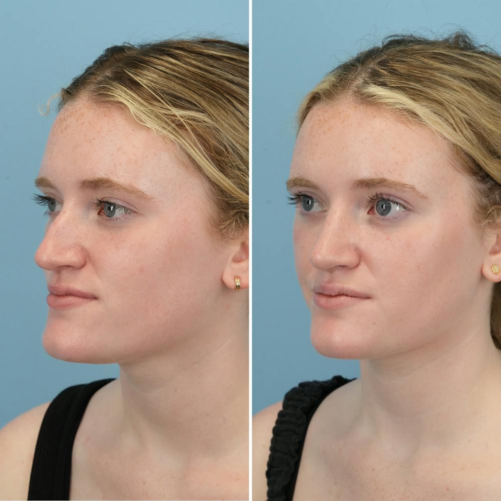 Rhinoplasty Before & After Gallery - Patient 176984344 - Image 2