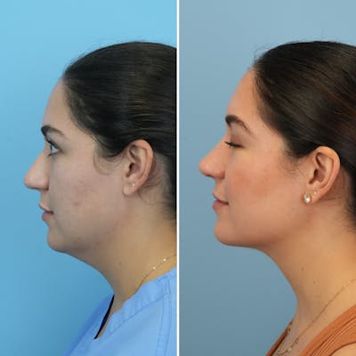 Rhinoplasty Before & After Gallery - Patient 176984795 - Image 1