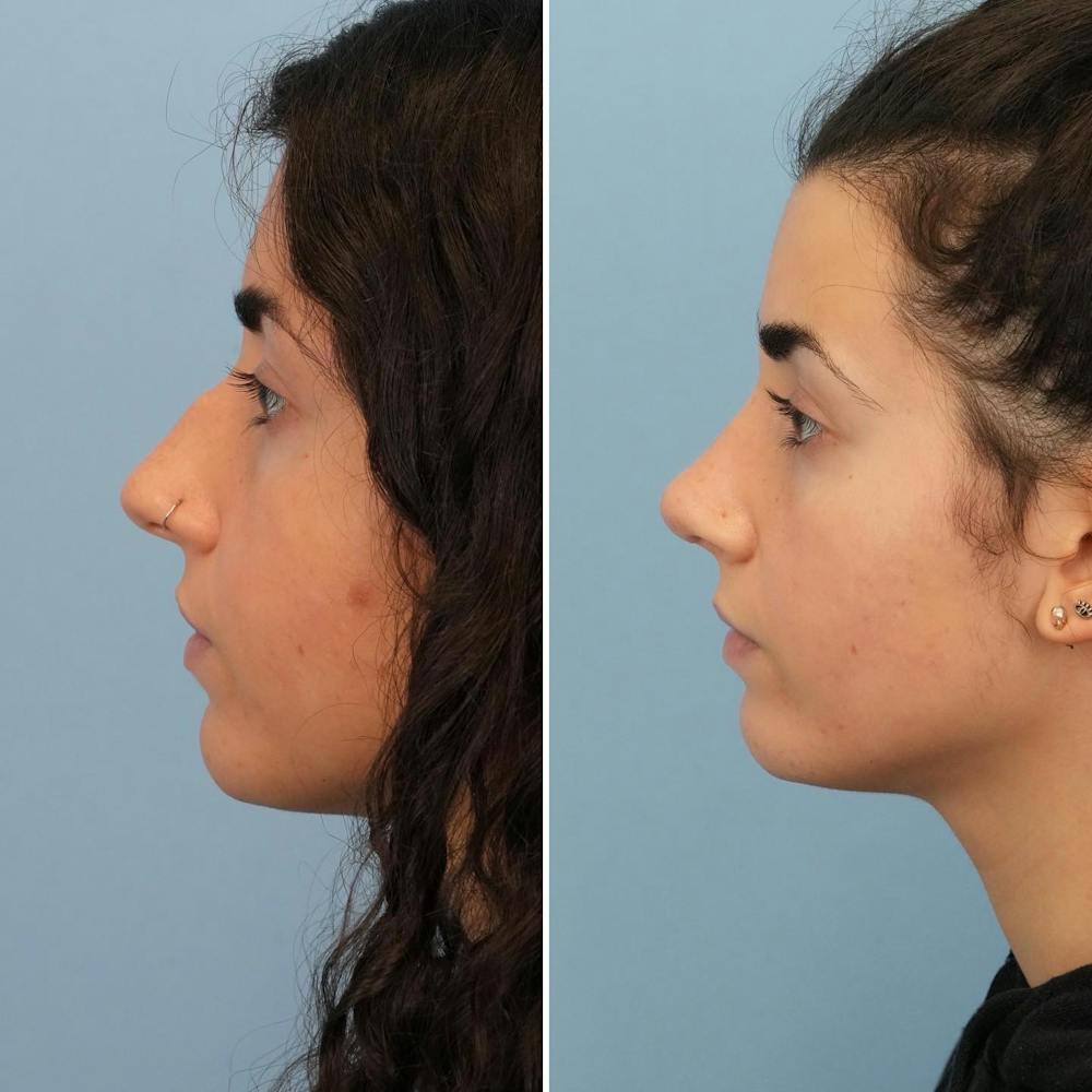 Rhinoplasty Before & After Gallery - Patient 176984797 - Image 5