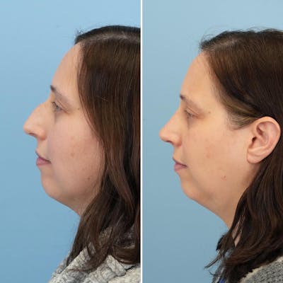 Rhinoplasty Before & After Gallery - Patient 176984804 - Image 1