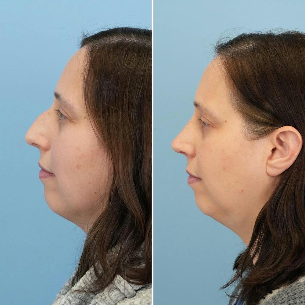 Rhinoplasty Before & After Gallery - Patient 176984804 - Image 1