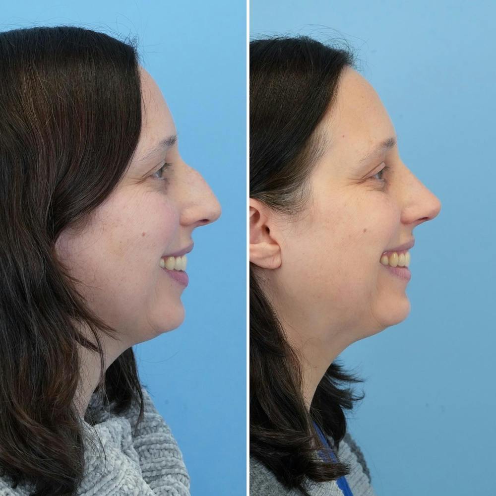 Rhinoplasty Before & After Gallery - Patient 176984804 - Image 3