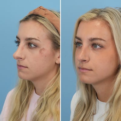 Rhinoplasty Before & After Gallery - Patient 176984346 - Image 2