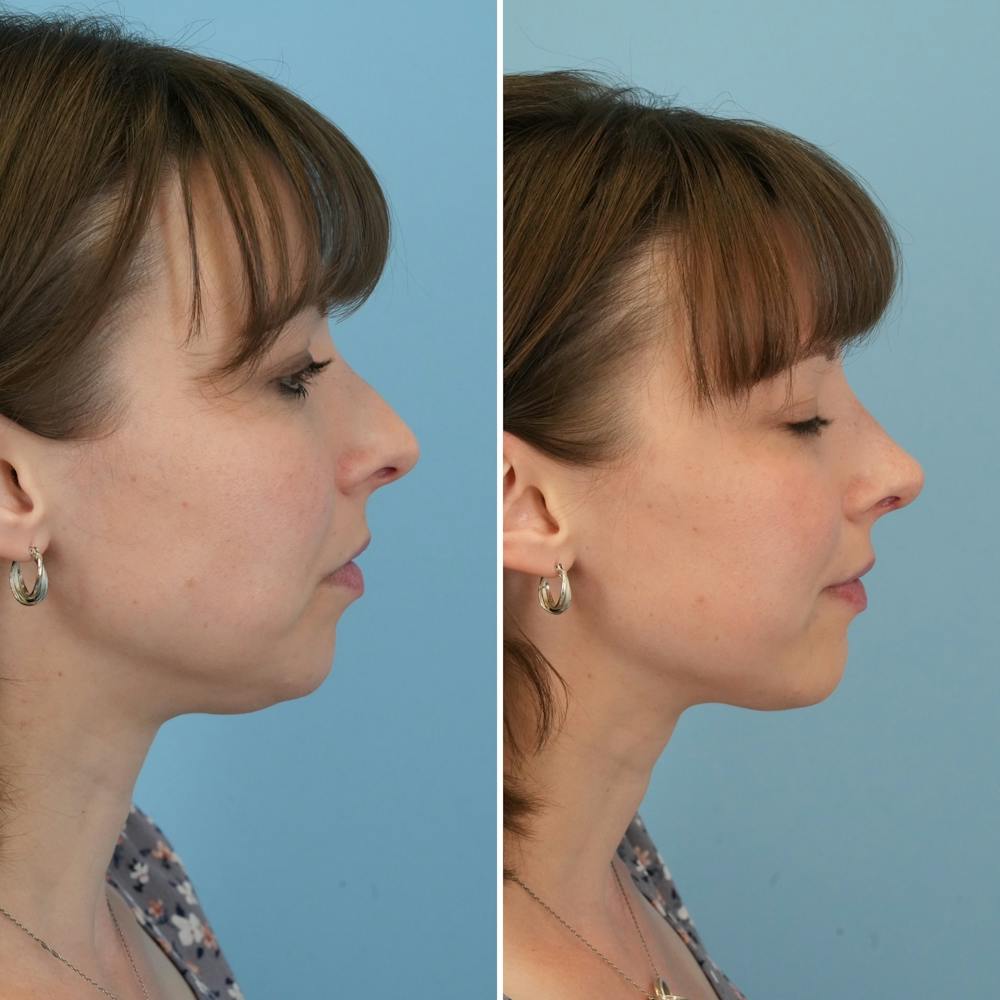 Rhinoplasty Before & After Gallery - Patient 176984799 - Image 3