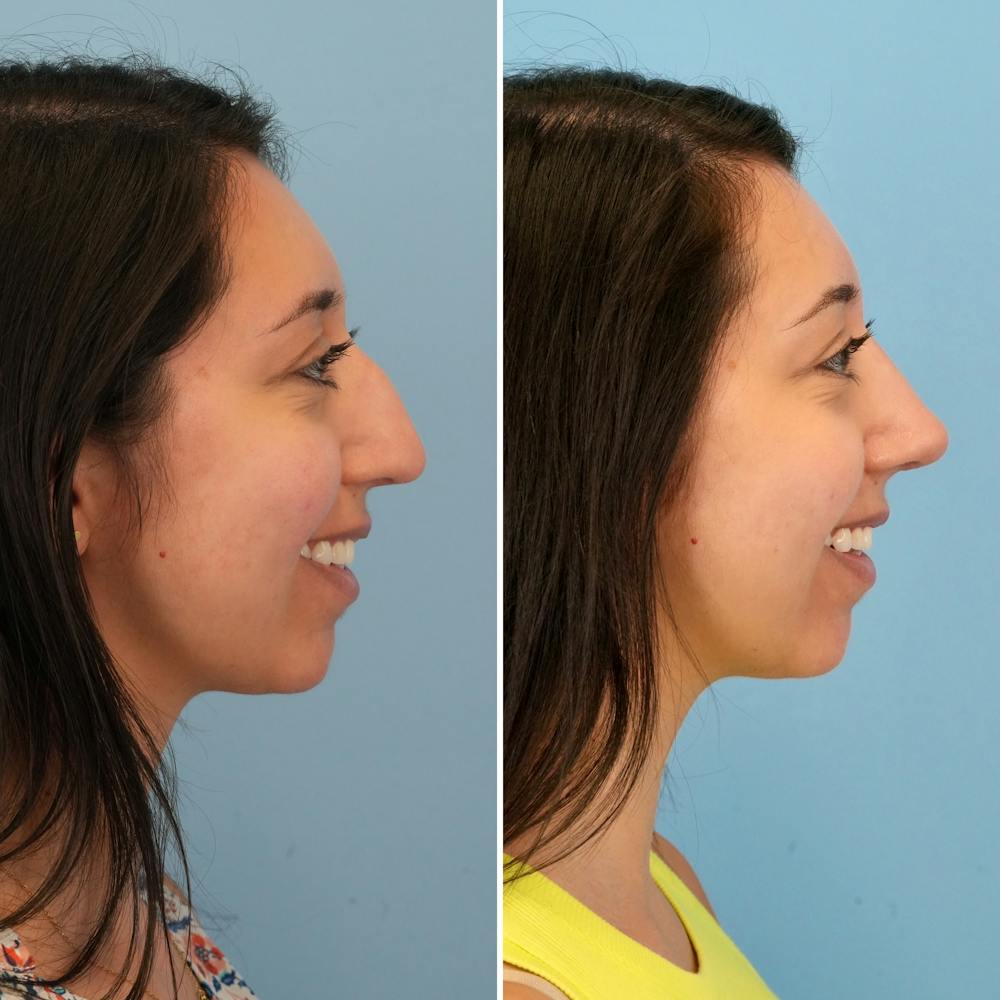 Rhinoplasty Before & After Gallery - Patient 176984817 - Image 5