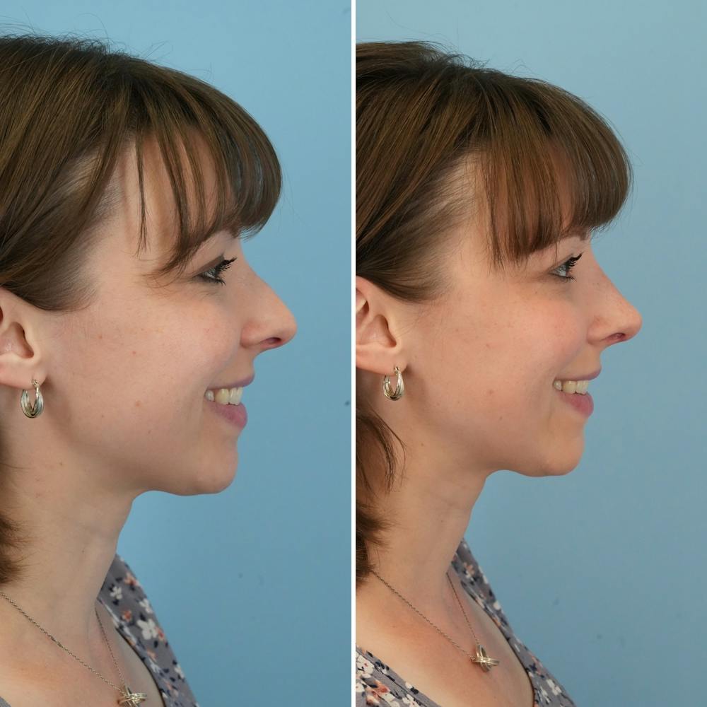 Rhinoplasty Before & After Gallery - Patient 176984799 - Image 4