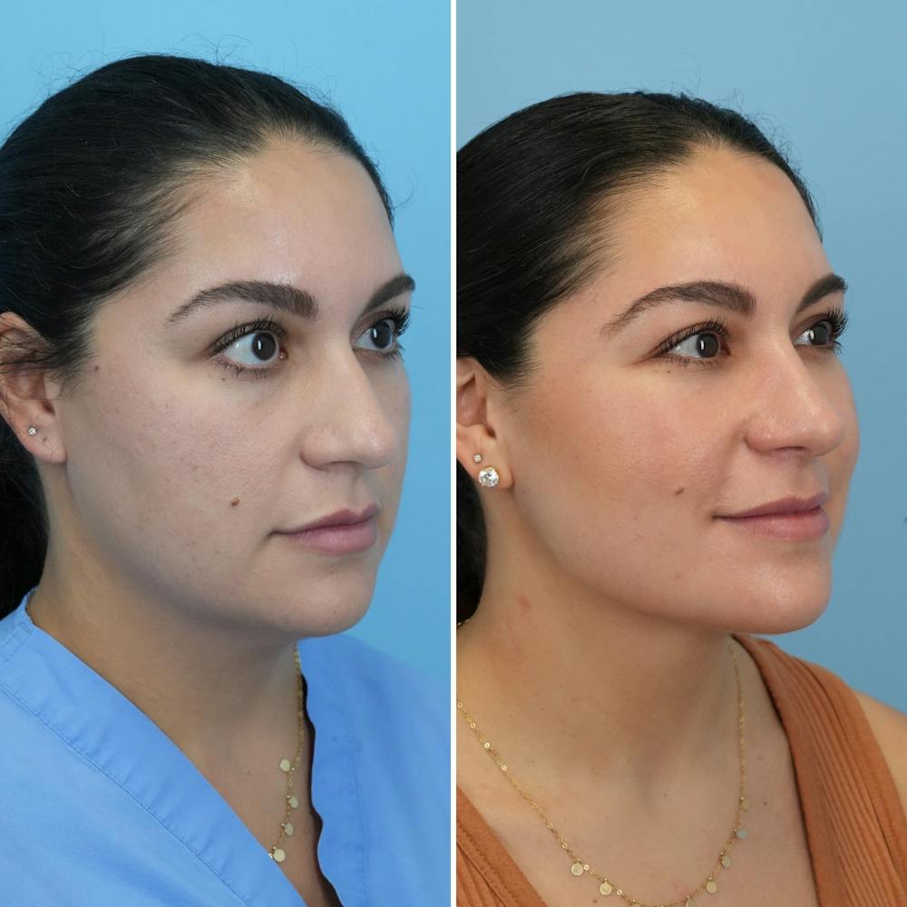 Rhinoplasty Before & After Gallery - Patient 176984795 - Image 7