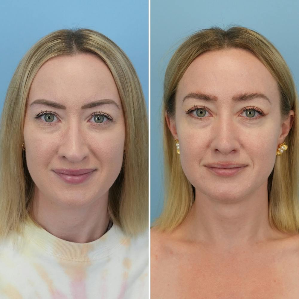 Rhinoplasty Before & After Gallery - Patient 176984818 - Image 2