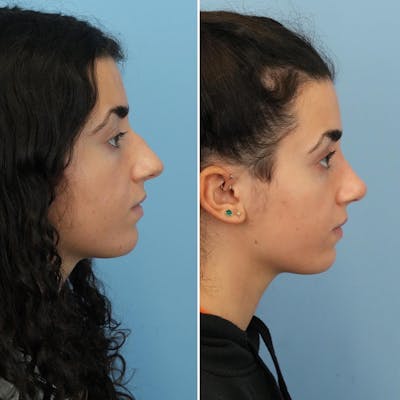 Rhinoplasty Before & After Gallery - Patient 176984797 - Image 1