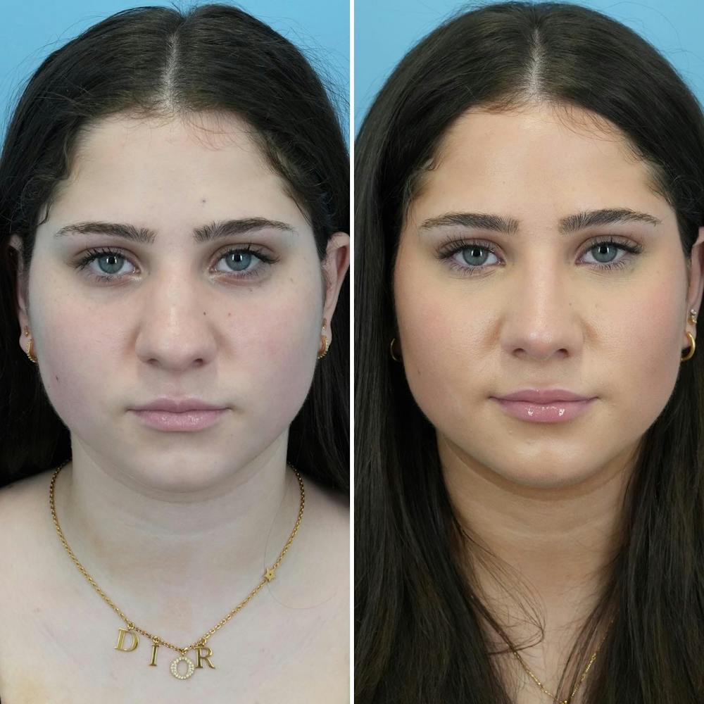 Rhinoplasty Before & After Gallery - Patient 176984807 - Image 3