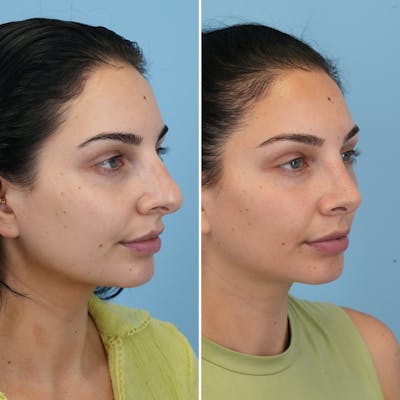 Rhinoplasty Before & After Gallery - Patient 176984803 - Image 6