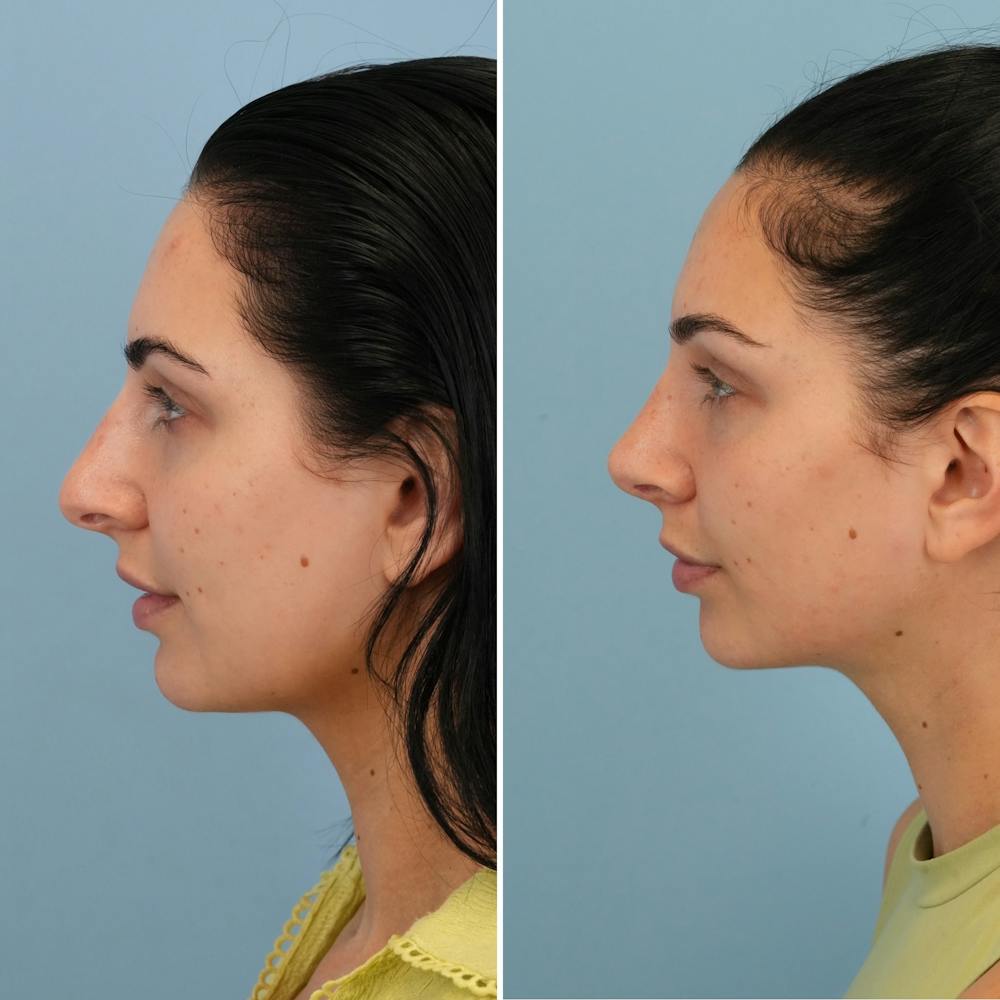 Rhinoplasty Before & After Gallery - Patient 176984803 - Image 1