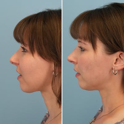 Rhinoplasty Before & After Gallery - Patient 176984799 - Image 1
