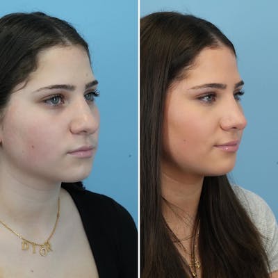 Rhinoplasty Before & After Gallery - Patient 176984807 - Image 4