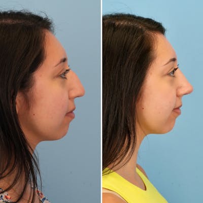 Rhinoplasty Before & After Gallery - Patient 176984817 - Image 6