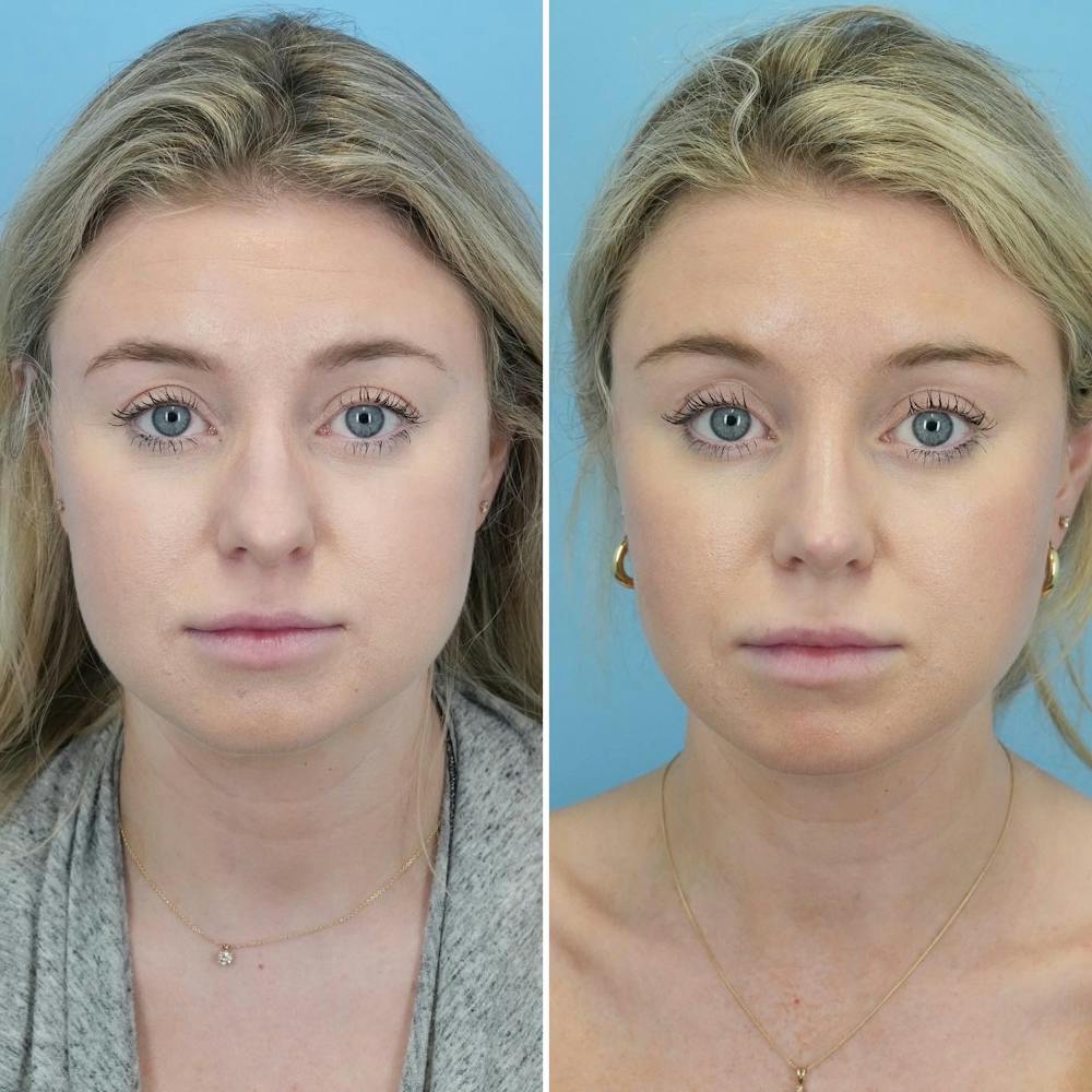 Rhinoplasty Before & After Gallery - Patient 176984805 - Image 2