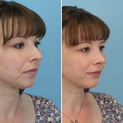 Rhinoplasty Before & After Gallery - Patient 176984799 - Image 6