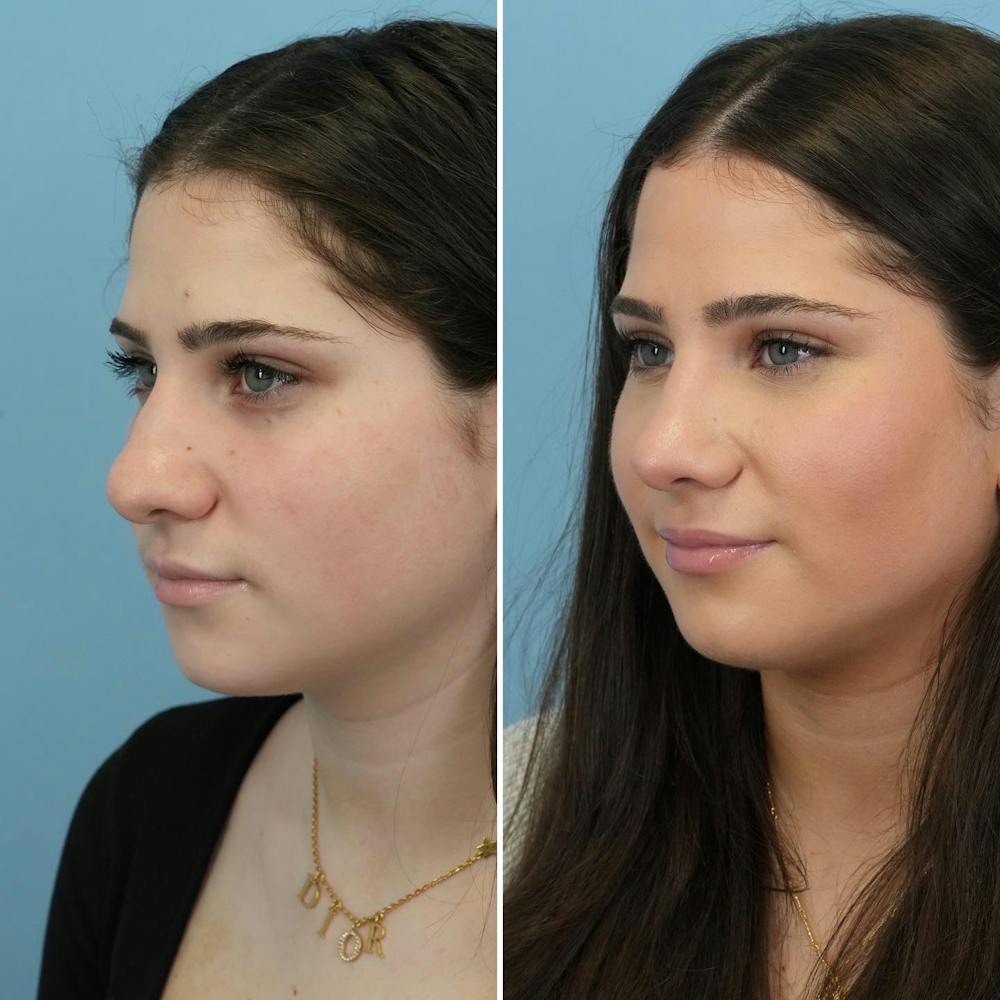 Rhinoplasty Before & After Gallery - Patient 176984807 - Image 5