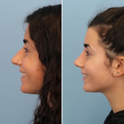 Rhinoplasty Before & After Gallery - Patient 176984797 - Image 6